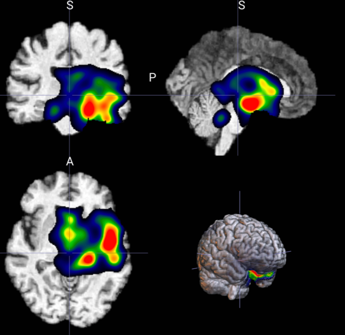 🧠 3D 图像分类模型SmoothGrad热力图生成